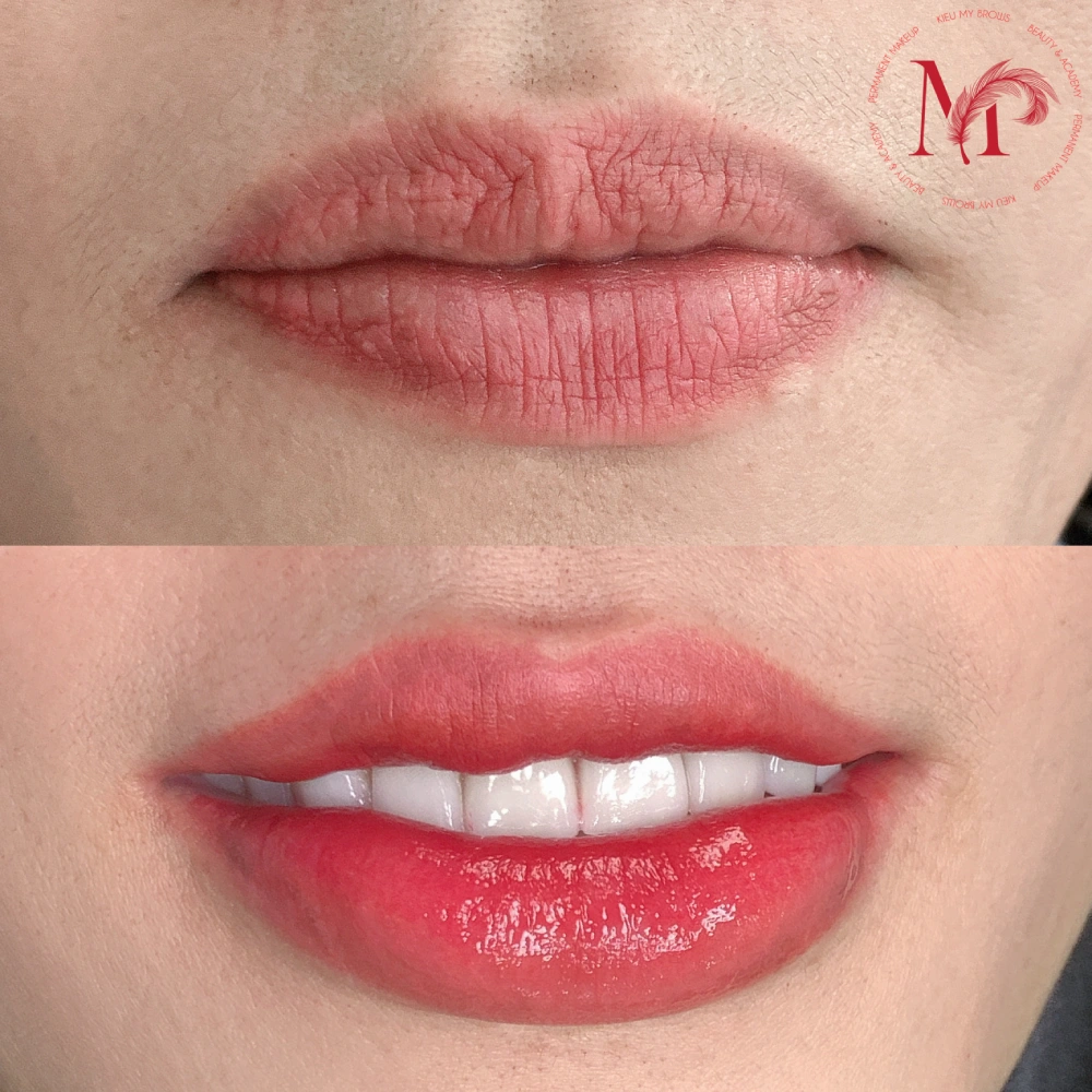 Before after môi 1