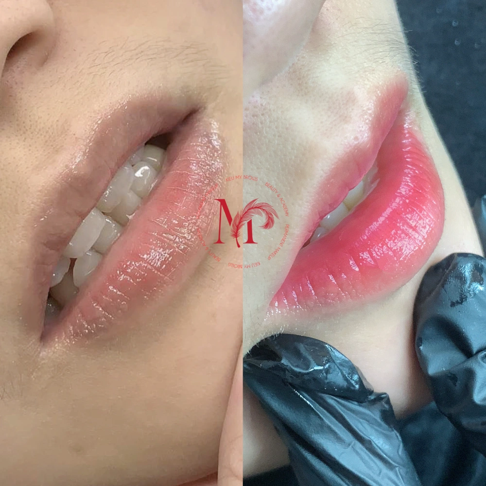 Before after môi 2