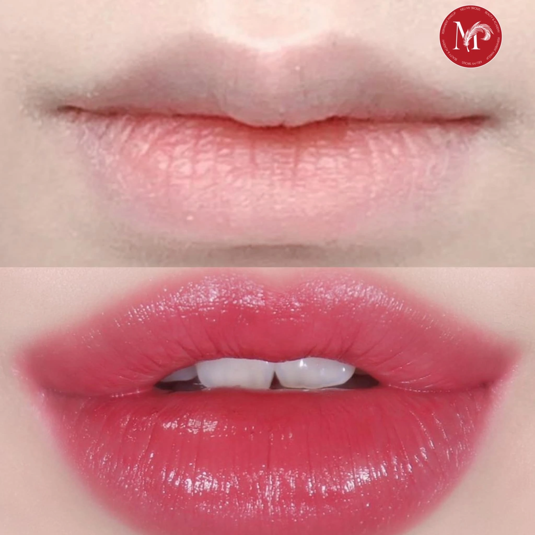 Before after môi 4